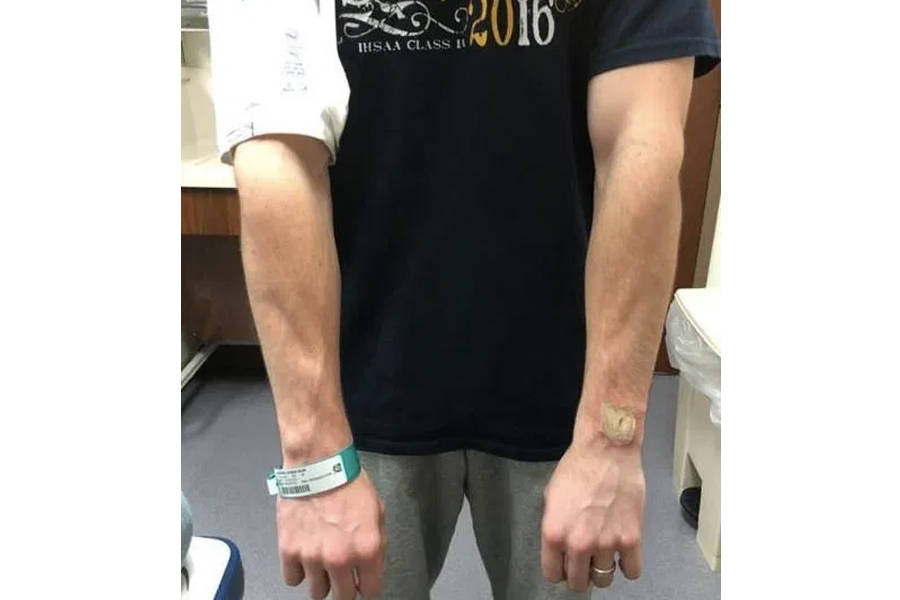 Fitbit smart fitness band explode caught fire on wrist google