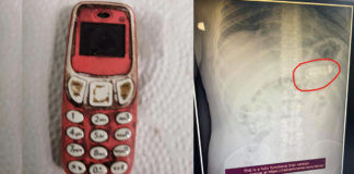 man-swallows-whole-nokia-3310-phone-endoscope-procedure-took-out-from-stomach