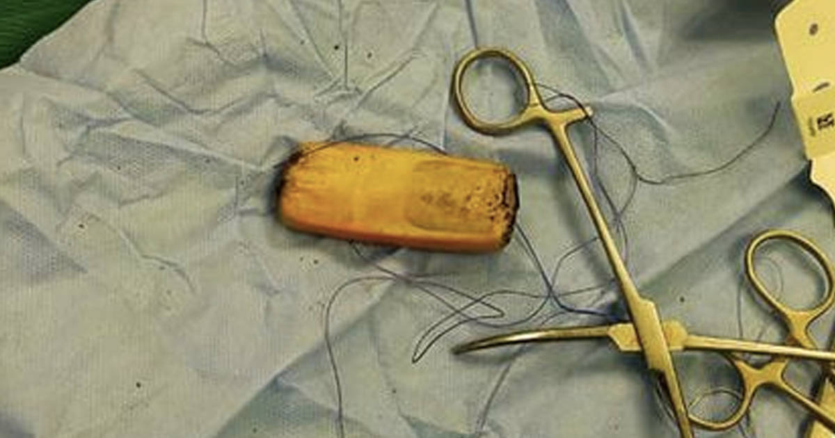 Zanco Tiny T1 mobile phone stuck in Stomach for 6 months doctors done surgery
